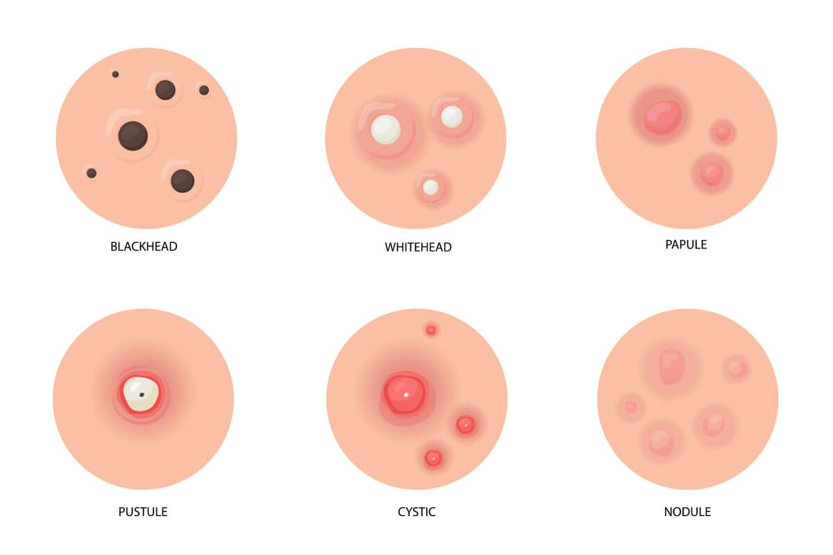 五種多功效的抗痘保養品
